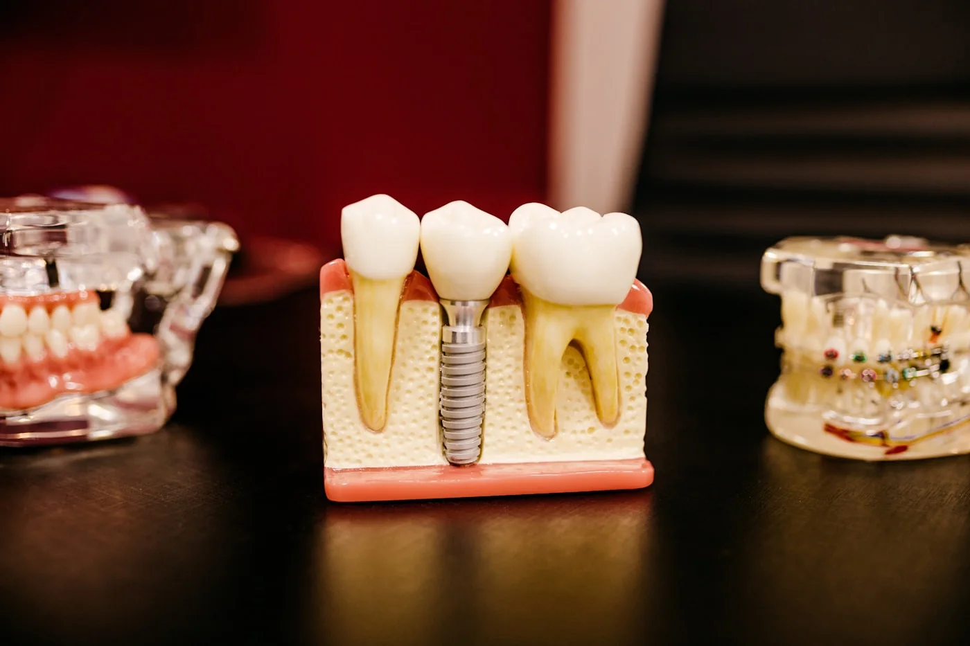 A dental implant model showing how implants fit