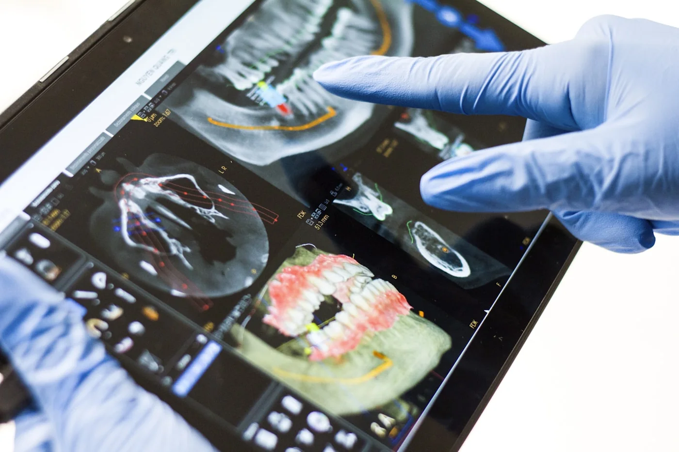 Digital implant planning on a dental scan
