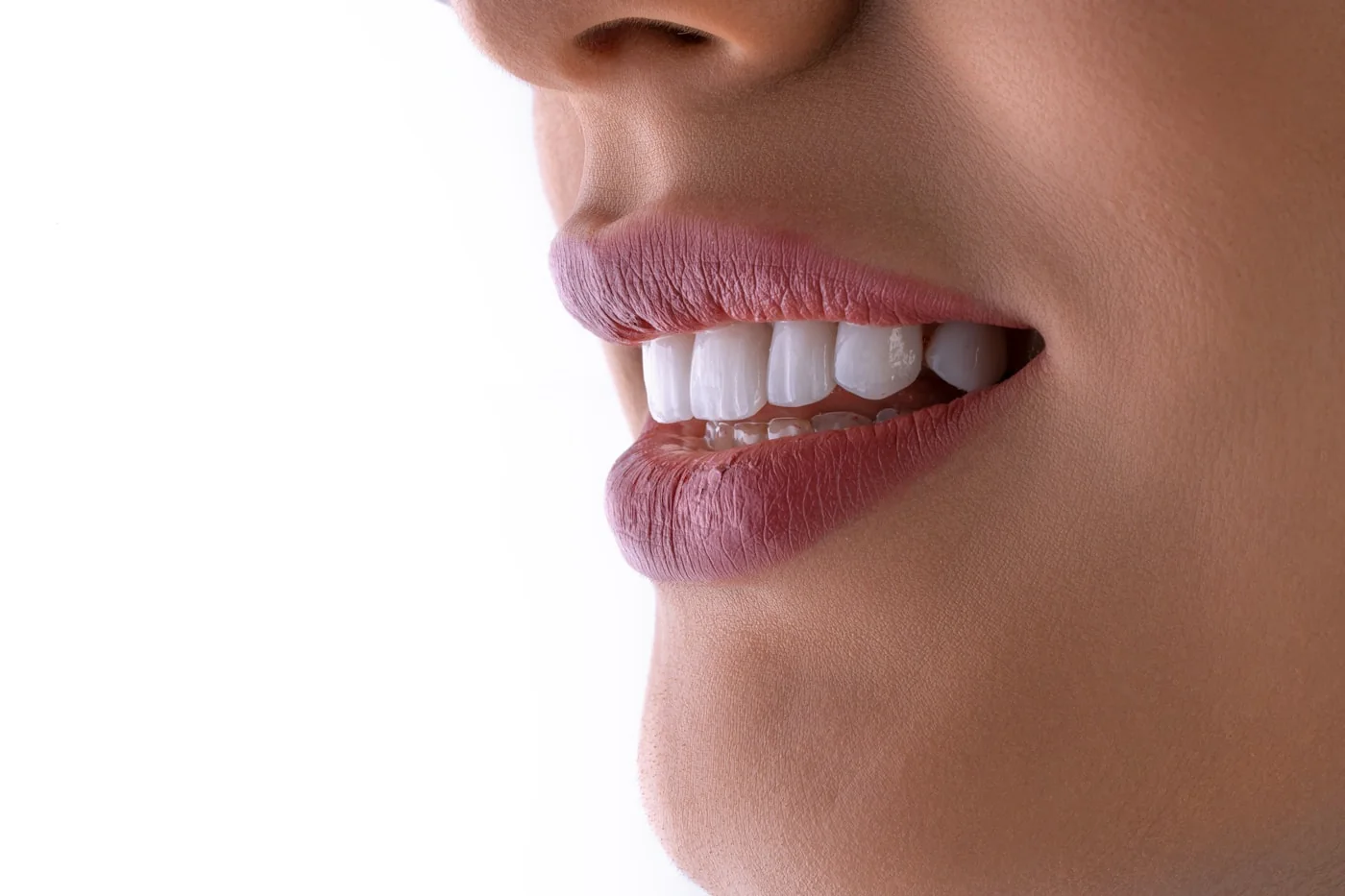 A close-up of a bright, healthy smile after whitening